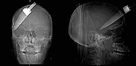 X-rays of Victim 1's skull with the knife embedded